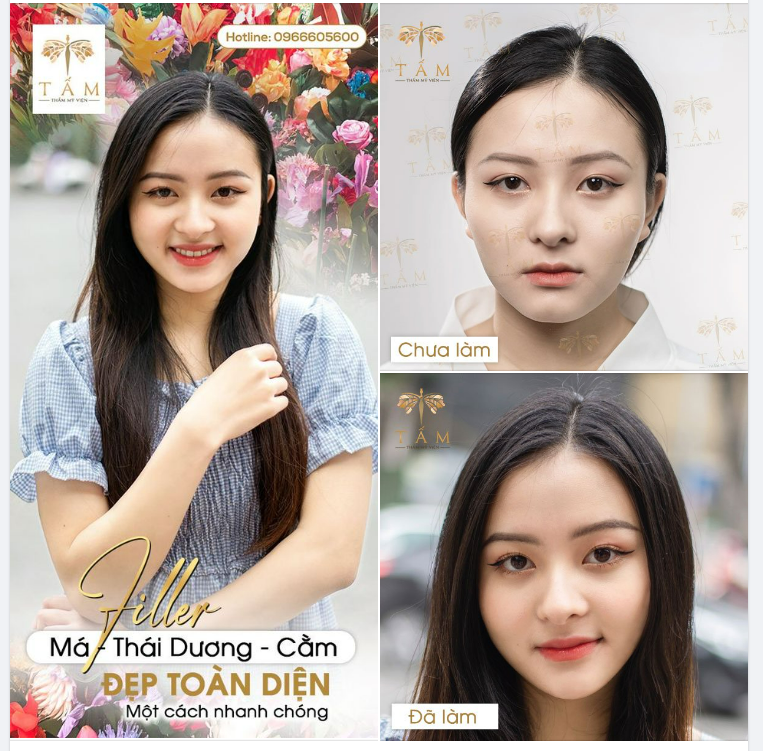 Làm đẹp bằng Filler là phương pháp nhẹ nhàng nhất trong thẩm mỹ hiện nay
