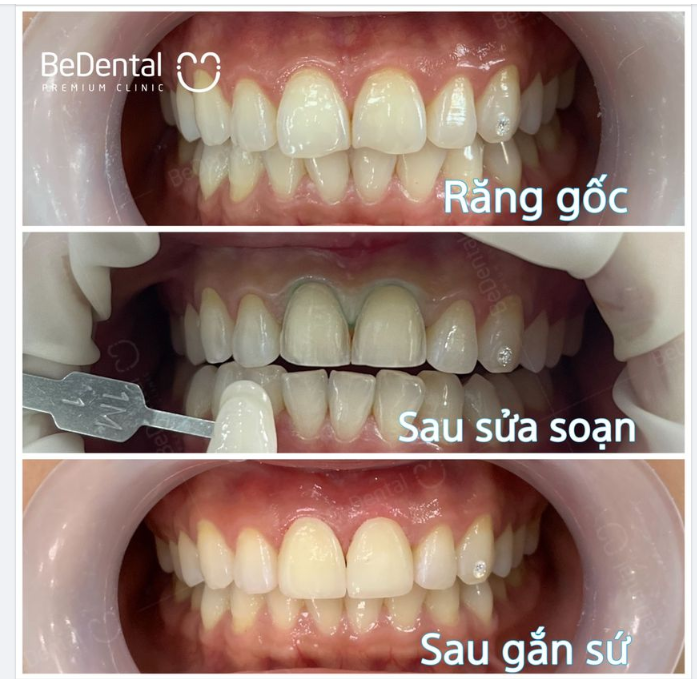 LÀM RĂNG Ở  BEDENTAL CAM KẾT KHÔNG MÀI NHỎ