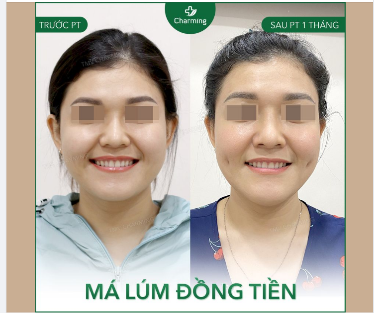 Lâu thật là lâu Charming mới có ảnh về phẫu thuật má lúm đồng tiền để khoe với chị em, nếu không chắc phẫu thuật này cũng bị chìm vào quên lãng mất .-.