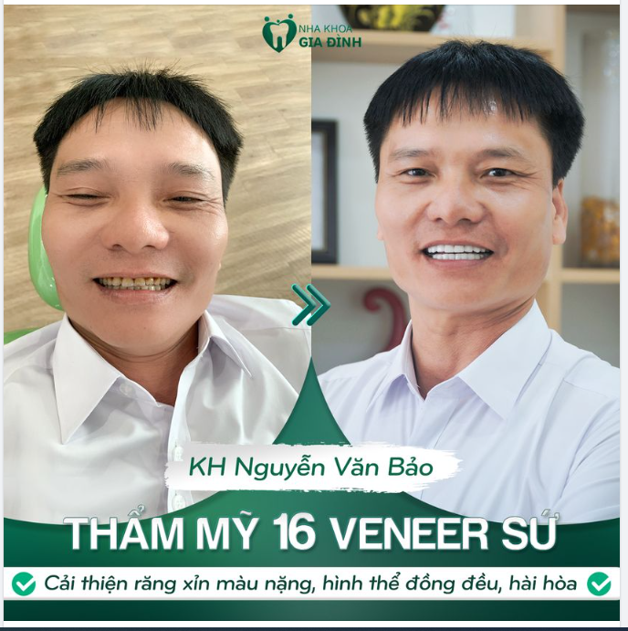 Lấy lại phong độ quý ông, trẻ hơn nhiều tuổi sau khi thay đổi hàm răng khuyết điểm