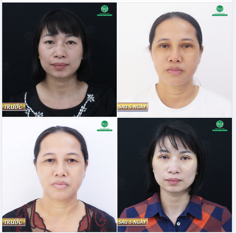 LẤY LẠI TUỔI TRẺ VỚI PHƯƠNG PHÁP CẮT MÍ MẮT