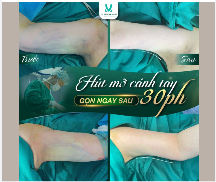 Loại bỏ m.ỡ thừa cánh tay - Nỗi băn khoăn của các chị em