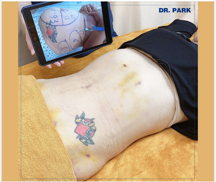 LOẠI BỎ MỠ THỪA 10 NĂM CHỈ TRONG 60 PHÚT HÃY GỌI TÊN CÔNG NGHỆ HÚT MỠ LIPO ULTRASOUND