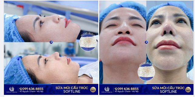 Loại bỏ những SỢI CƯỚC - rước ngay mũi tài lộc