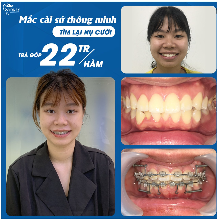 LÝ DO NÊN LỰA CHỌN MẮC CÀI SỨ THÔNG MINH 