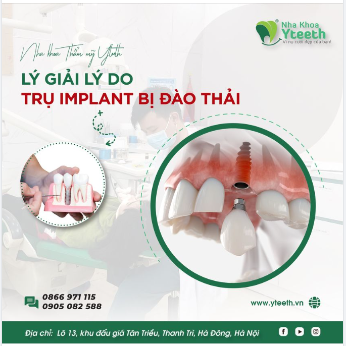 LÝ GIẢI LÝ DO RĂNG IMPLANT BỊ ĐÀO THẢI