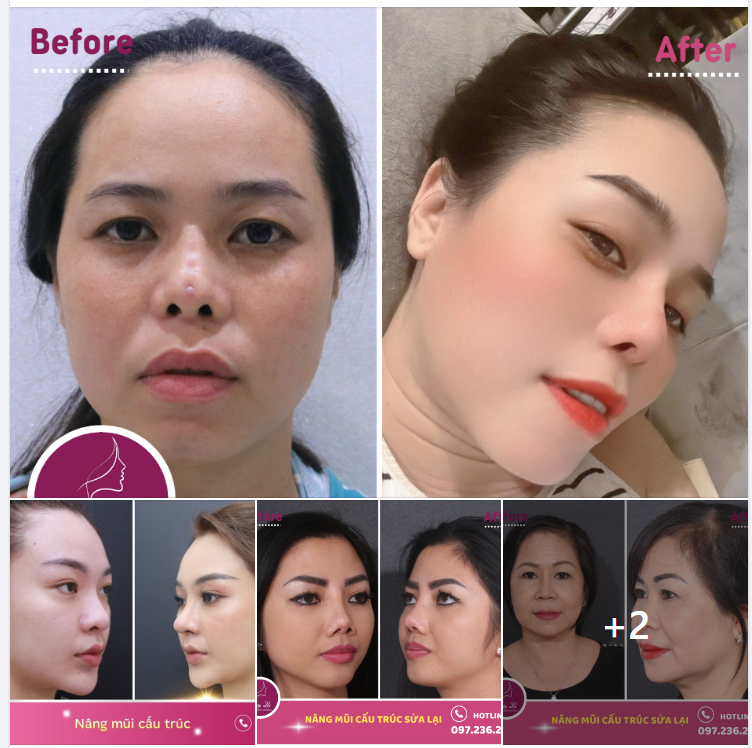 MẤT BAO NHIÊU ĐỂ SỬA 1 CHIẾC MŨI HỎNG