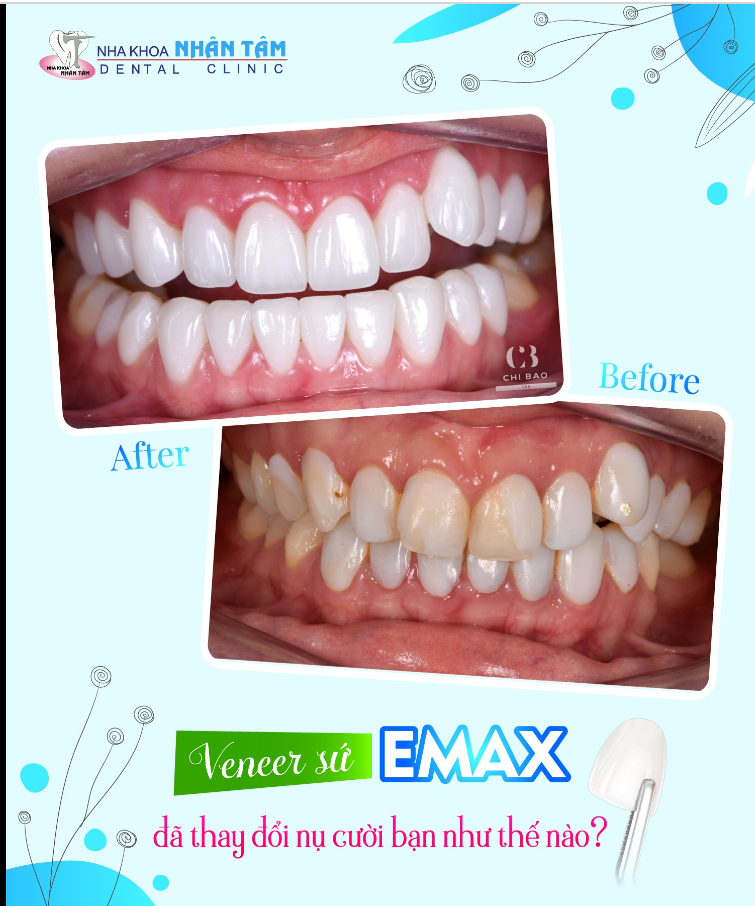 Mặt dán sứ Veneer Emax đã thay đổi nụ cười của bạn như thế nào?