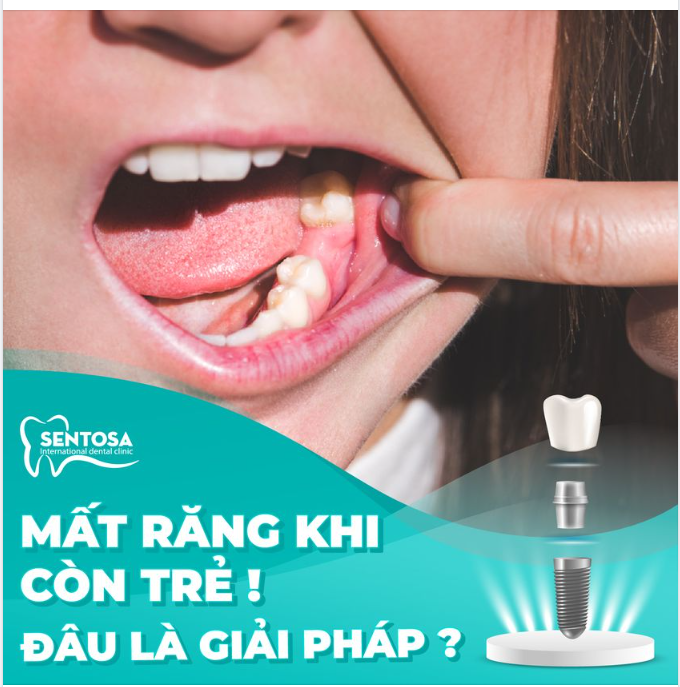 MẤT RĂNG KHI CÒN TRẺ - ĐÂU LÀ GIẢI PHÁP