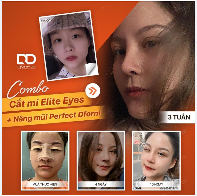 MẮT THẦN THÁI - MŨI CAO SANG COMBO NÂNG MŨI PERFECT DFORM + CẮT MÍ ELITE EYES