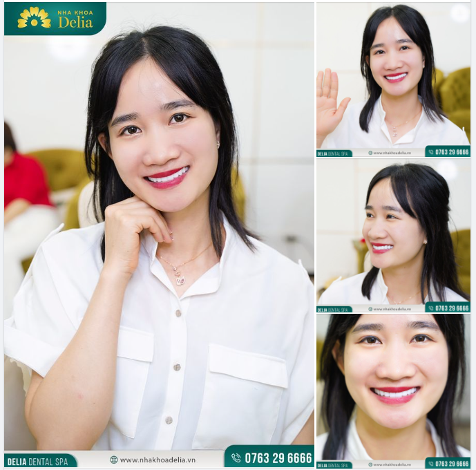 Mình đã tự tin hơn rất nhiều sau khi làm răng, nụ cười rạng rỡ đã được tìm lại tại Delia. Thật sự rất hài lòng!"