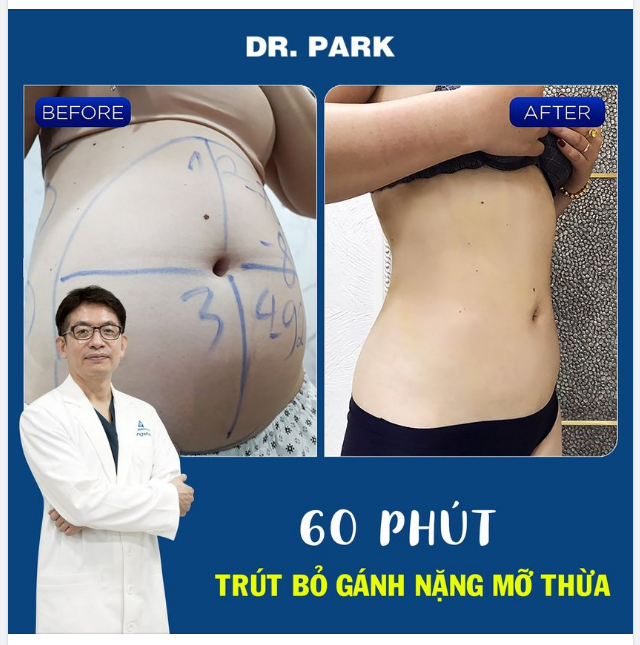MỠ BỤNG – LOẠI BỎ DỄ DÀNG HƠN NHIỀU VỚI LIPO ULTRASOUND