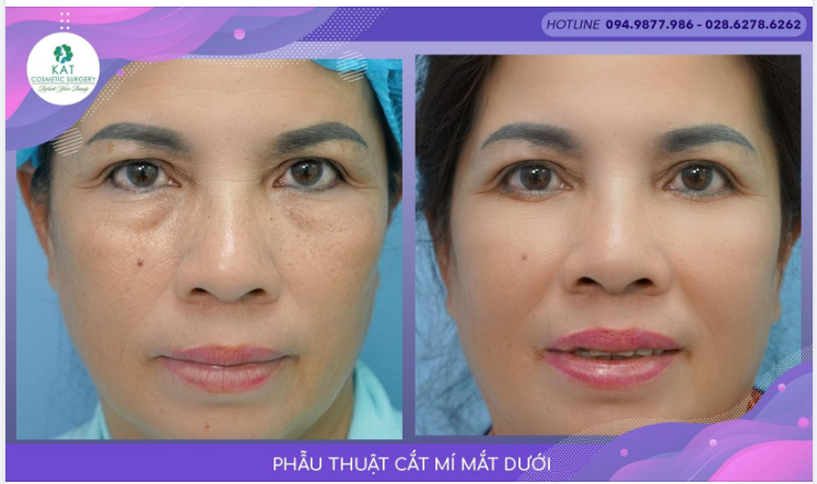 “Mọi ưu phiền mệt mỏi tan theo cắt mí dưới ”