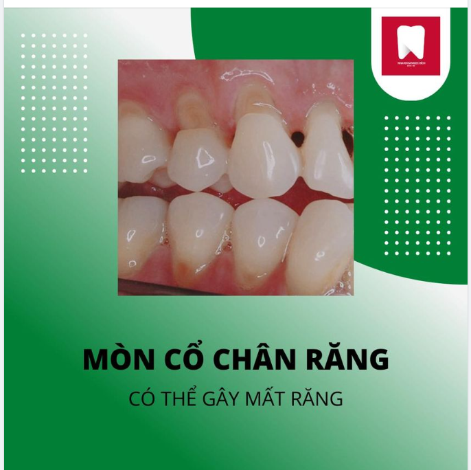 MÒN CỔ CHÂN RĂNG CÓ THỂ DẪN ĐẾN MẤT RĂNG