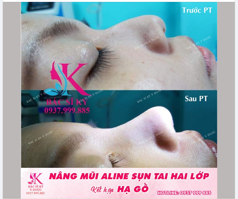 MỘT CA NÂNG MŨI KHÓ - DÁNG MŨI GỒ GHỀ TRŨNG SÂU.