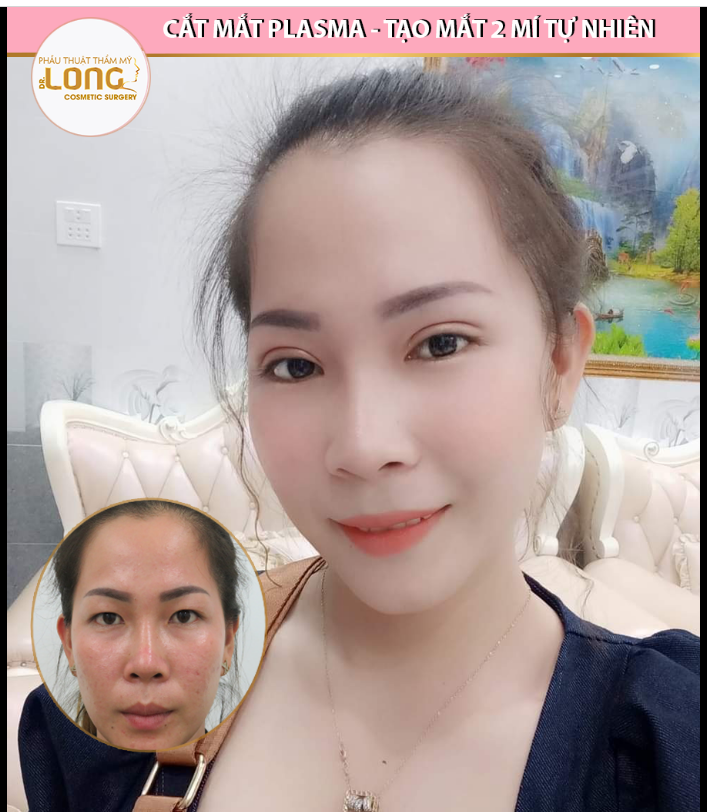 Một chút mí xinh cho đôi mắt lung linh