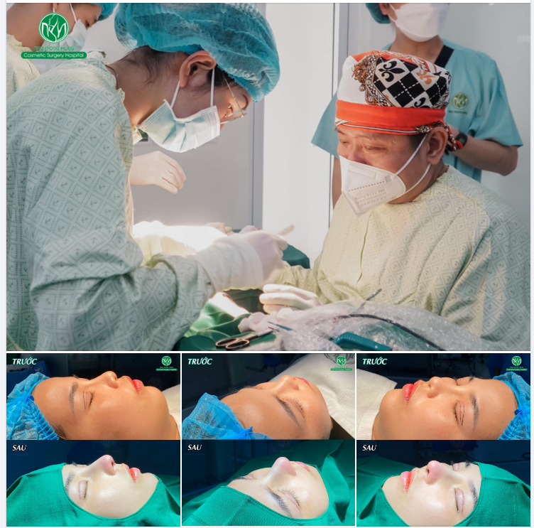 MỘT KẾT QUẢ KH THỰC HIỆN CÙNG LÚC COMBO NÂNG MŨI + CẮT MÍ