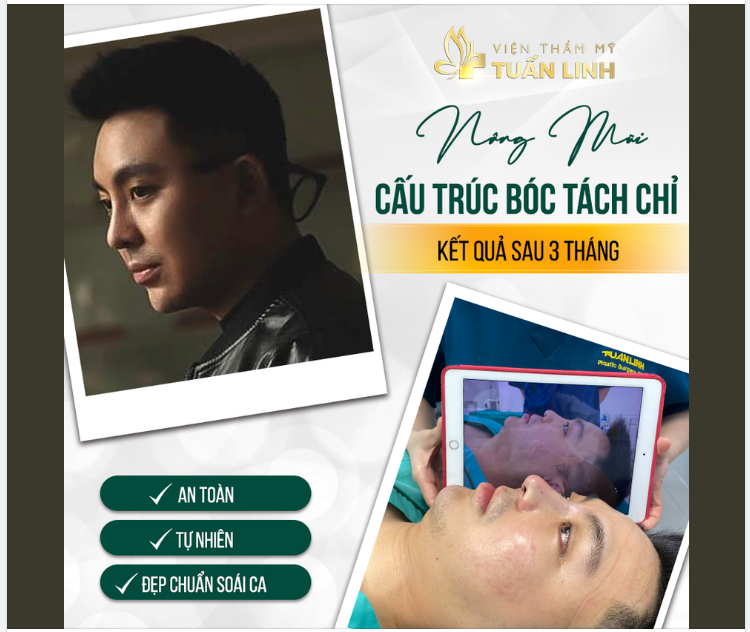 MŨI BẠN BỊ - Thấp tẹt, cánh mũi to bè. - Lựa chọn phương pháp nâng mũi chỉ nhưng không lên được dáng mũi theo mong muốn.