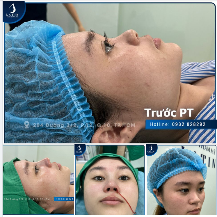 MŨI BÁN CẤU TRÚC CHỈNH HÌNH NỀN