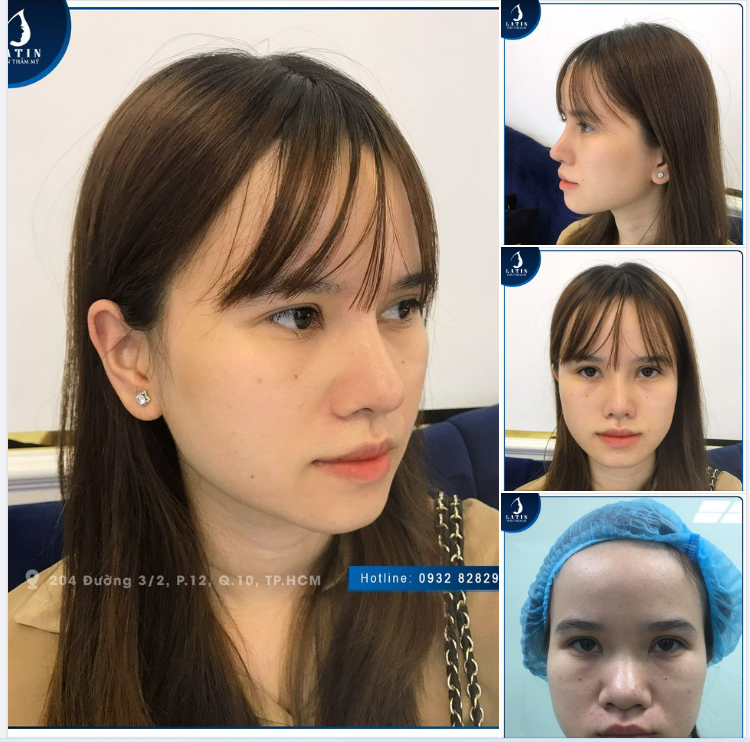 MŨI BÁN CẤU TRÚC