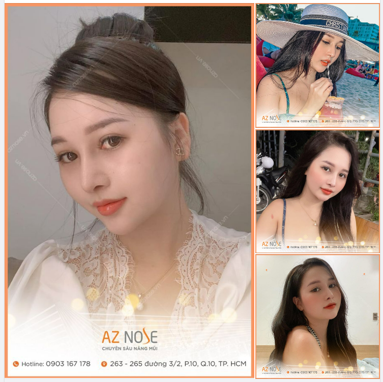 Mũi bây giờ xinh lắm, không uổng công mình bay từ Đà Nẵng vào làm