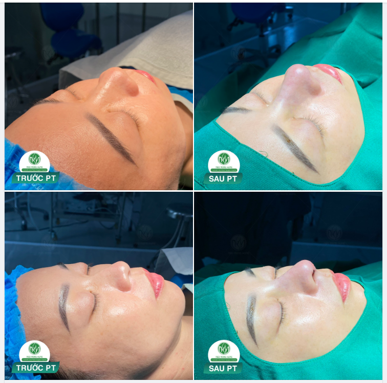 MŨI CAO ẤN TƯỢNG VỚI FORM MŨI S LINE