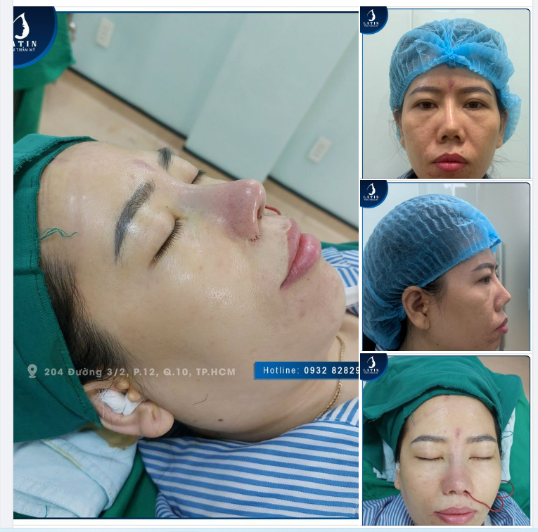 MŨI BÁN CẤU TRÚC - THU PHỤC THẦN THÁI