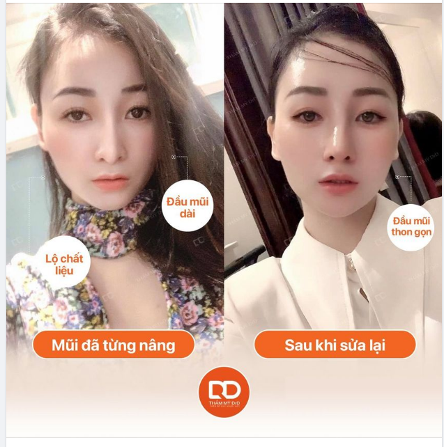 MŨI ĐÃ TỪNG CAN THIỆP NHƯNG CHƯA HÀI LÒNG CÓ SỬA LẠI ĐƯỢC KHÔNG