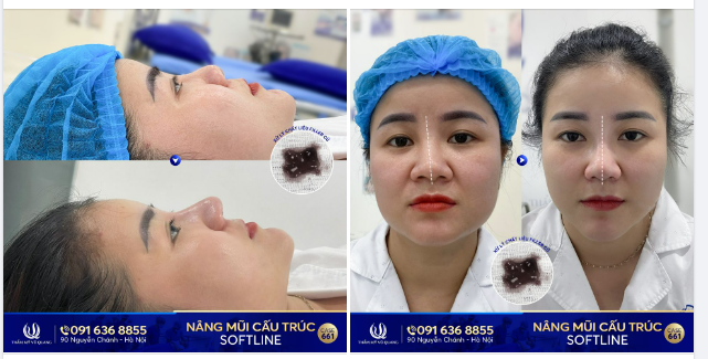 Mũi đã từng tiêm Filler, tưởng đẹp.. Không ngờ phải sửa lại
