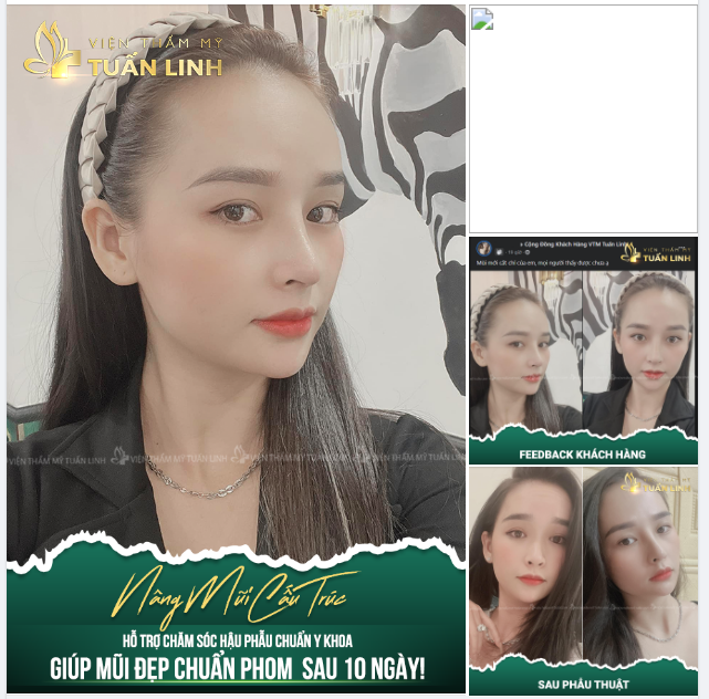 MŨI ĐẸP CHUẨN PHOM CHỈ SAU 10 NGÀY !!!