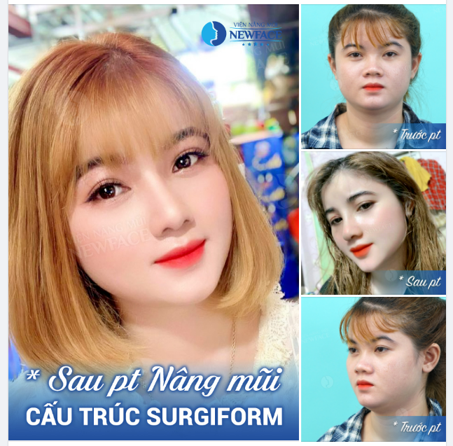 MŨI GÃY HÓA MŨI XINH “GIẬT MÌNH” VÌ CỰC PHẨM NÂNG MŨI CẤU TRÚC