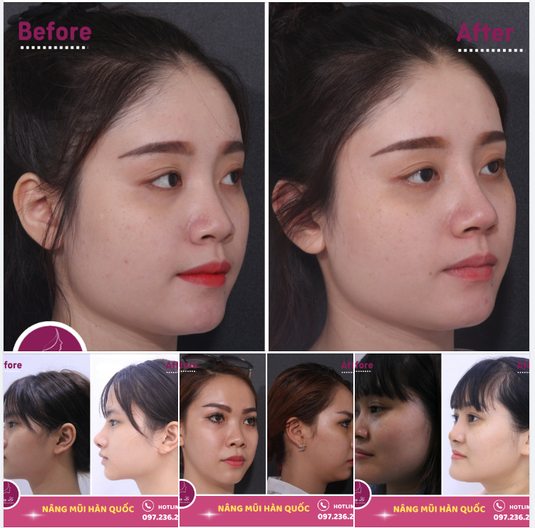 MŨI HÀN QUỐC “GIÁ XẸP” VẪN LÊN FORM CỰC ĐẸP
