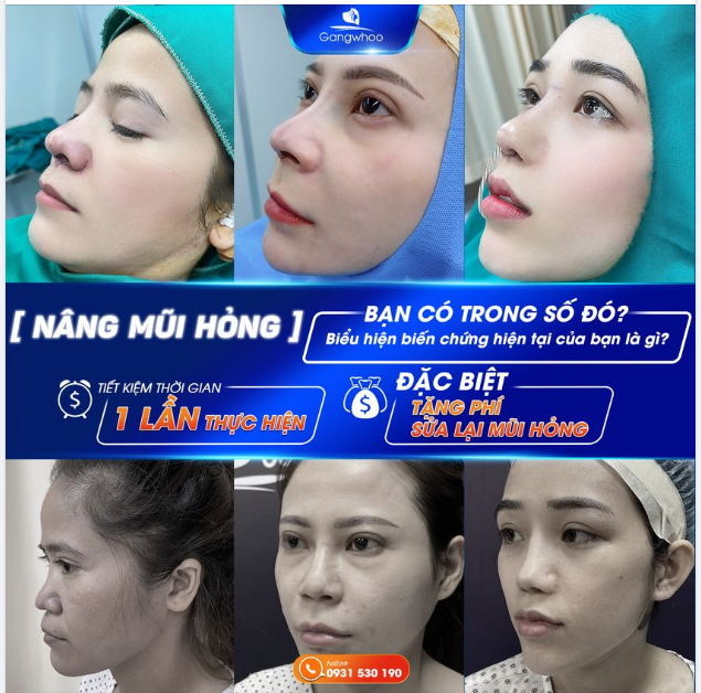 MŨI HỎNG - ĐỪNG ĐỂ NẶNG MỚI SỬA!
