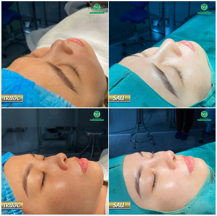 MŨI MEGADERM CHO KH THÍCH DÁNG MŨI TỰ NHIÊN