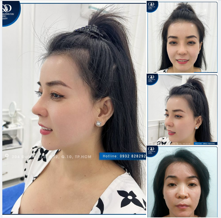 MŨI NHƯ Ý - ĐẸP MÊ LY
