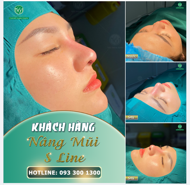 MŨI S LINE KHẮC PHỤC MỌI KHUYẾT ĐIỂM