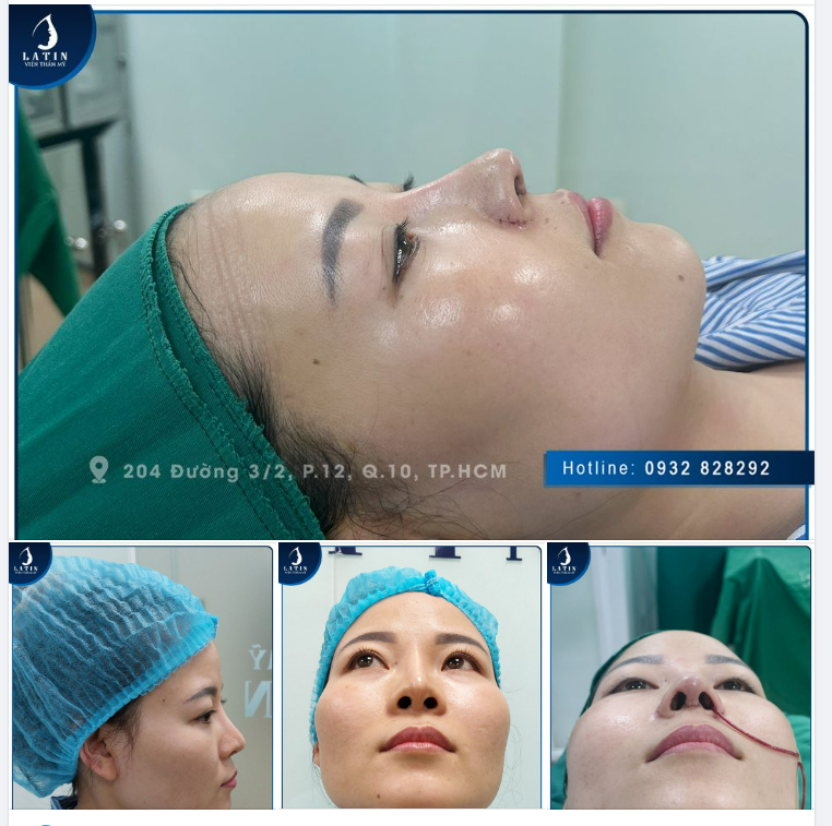 Mũi sửa lại cấu trúc bọc lot surgiform 