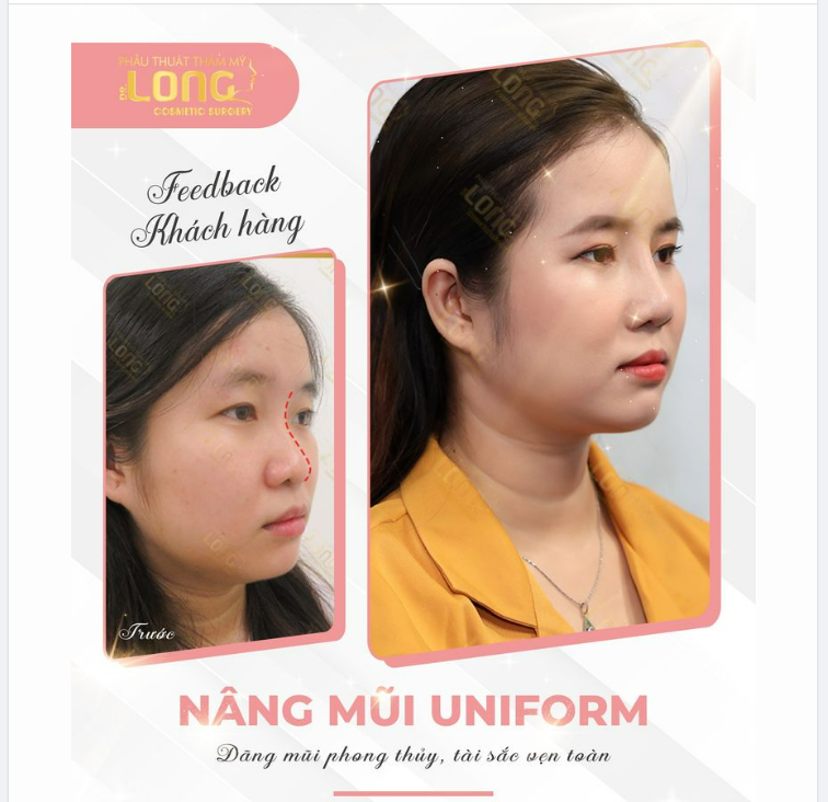 MŨI “THẤP” HÓA “CAO” LÀM SAO KHÔNG THỰC HIỆN ĐƯỢC