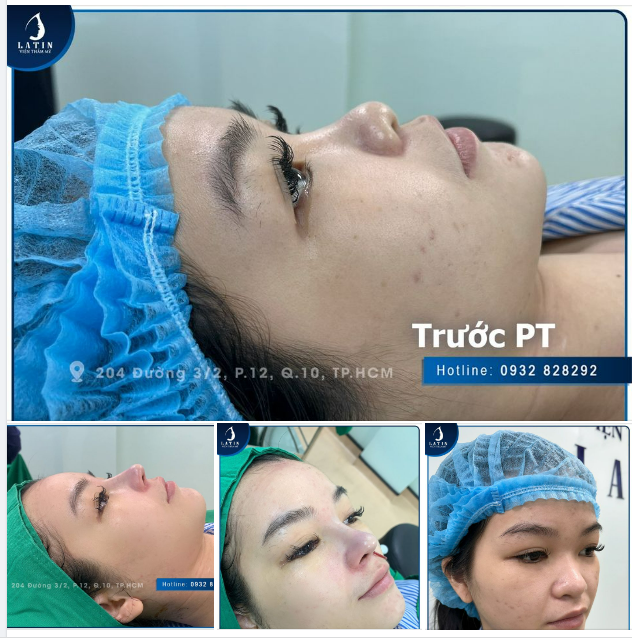 Mũi thấp, không có gốc mũi, sau khi nâng mũi bán cấu trúc sẽ như thế nào