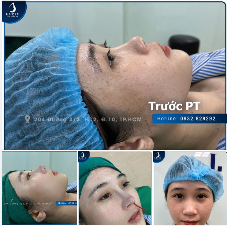 MŨI XINH LUNG LINH - HÚT MỌI ÁNH NHÌN