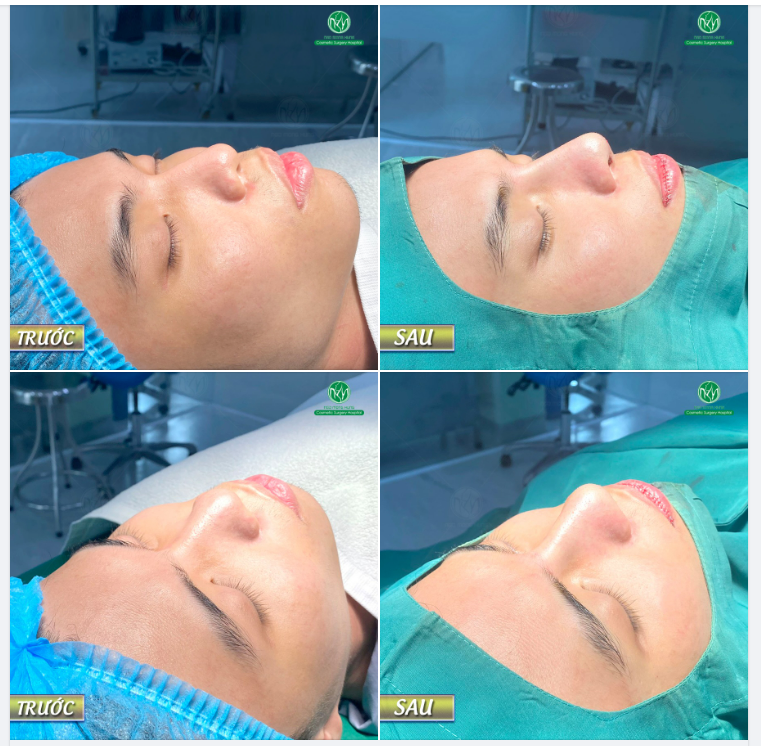 NAM TÍNH HƠN NHỜ NÂNG MŨI