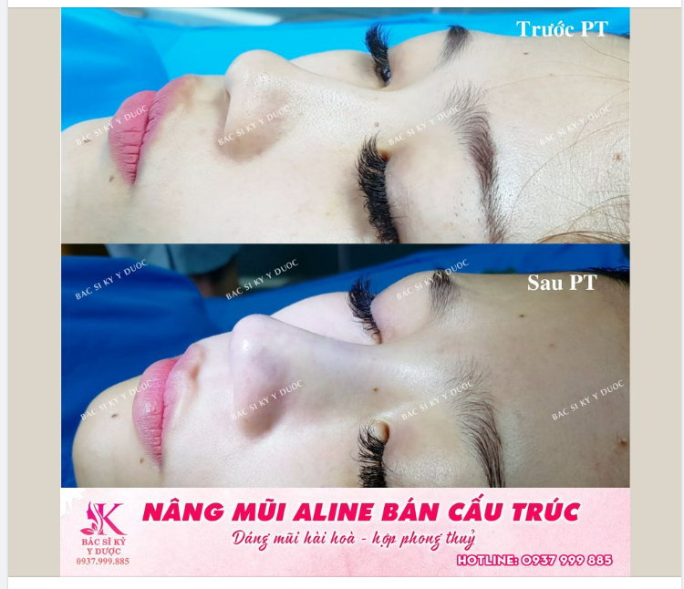 NÂNG MŨI ALINE BÁN CẤU TRÚC - DÁNG MŨI VẠN NGƯỜI MÊ