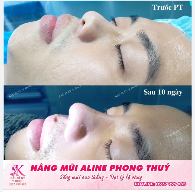 NÂNG MŨI ALINE PHONG THỦY NÂNG TẦM THU HÚT CHO BẠN NAM