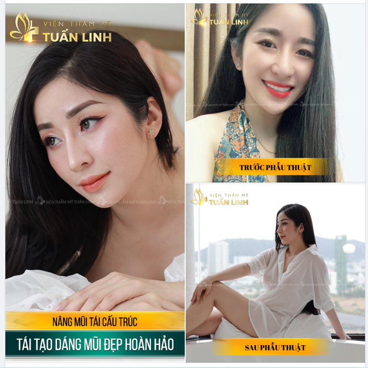 NÂNG MŨI BỊ HỎNG - NỖI ÁM ẢNH KHÔNG CỦA RIÊNG AI