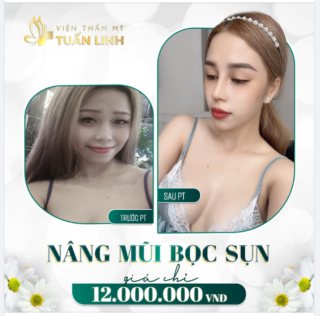 NÂNG MŨI BỌC SỤN - CAO NHẸ NHÀNG - ĐẸP THANH TÚ