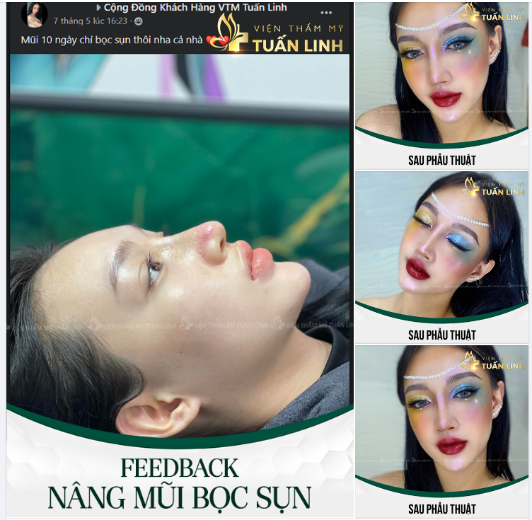 NÂNG MŨI BỌC SỤN - CAO TỰ NHIÊN - ĐẸP NỔI BẬT