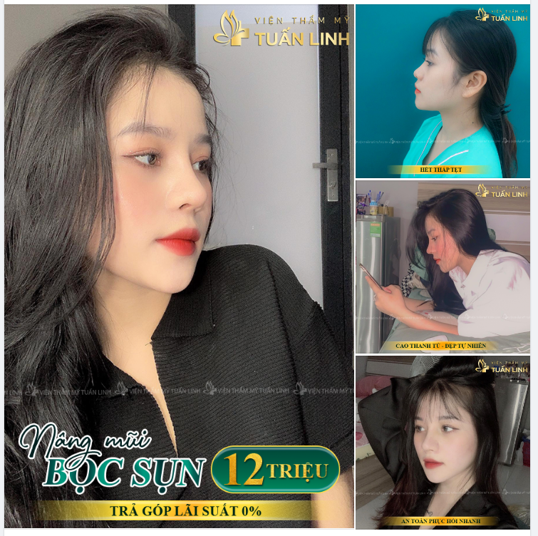 Nâng mũi bọc sụn -cao thanh tú - đẹp tợ nhiên