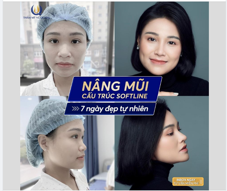 Nâng mũi cao sang - Đẹp chuẩn hot girl.