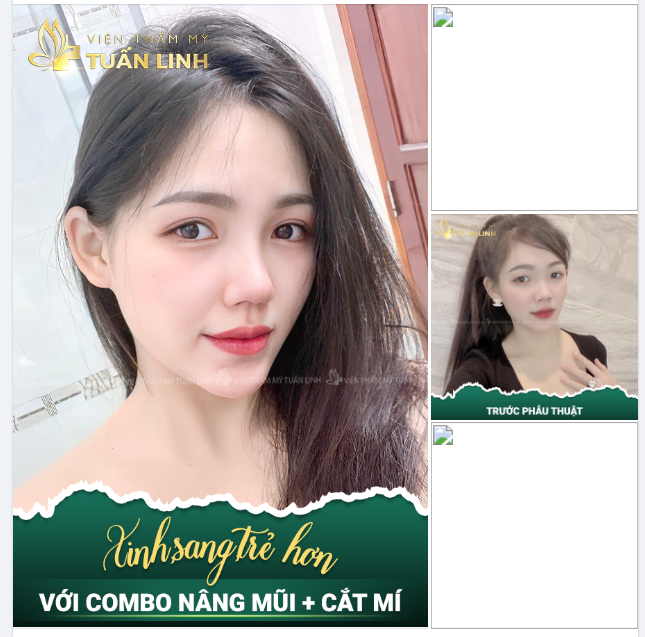 NÂNG MŨI + CẮT MÍ - COMBO CHO KHUÔN MẶT XINH SANG VÀ TRẺ ĐẸP