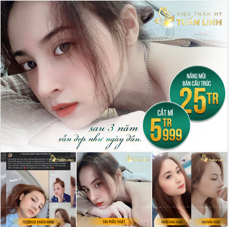 NÂNG MŨI + CẮT MÍ SAU 3 NĂM VẪN ĐẸP NHƯ NGÀY ĐẦU!!!